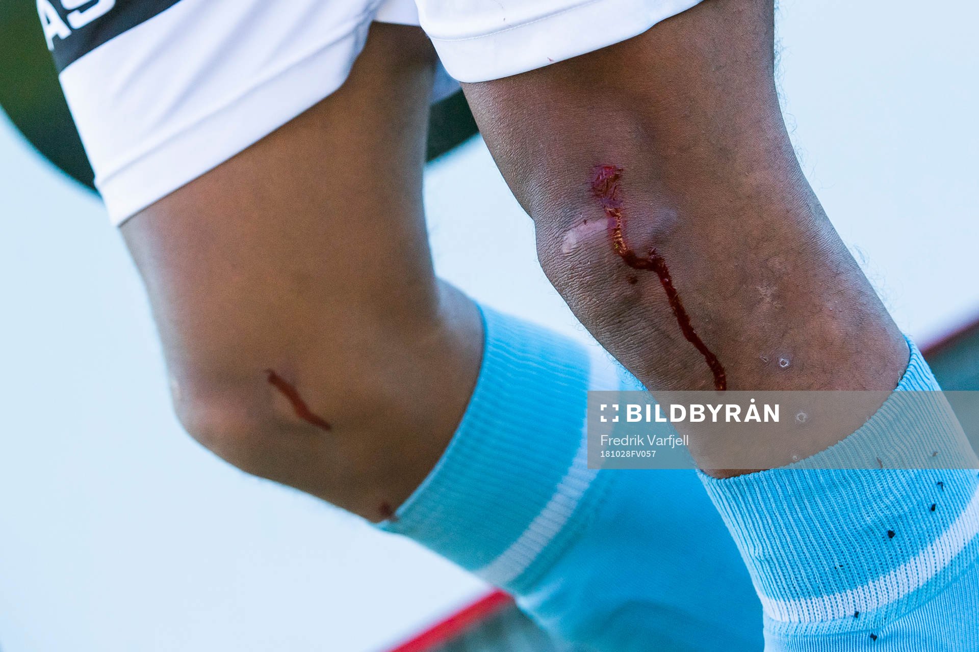 The knee of Erixon Danso of Sandnes Ulf