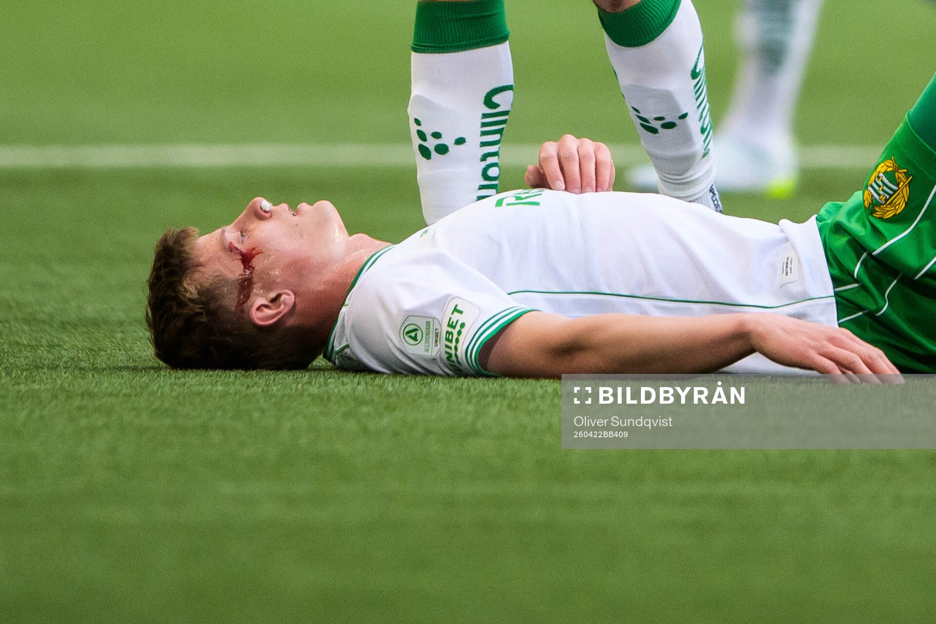 Hammarbys Frederik Winther blöder från huvudet
