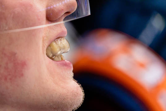 Växjös Niclas Lundgren tandskydd